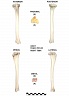 Tibia droit