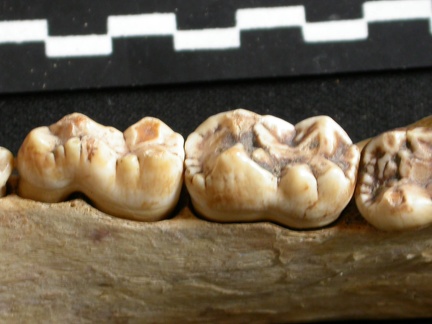 Dentition inférieure