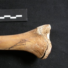  Tibia: distal part