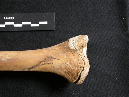  Tibia: distal part