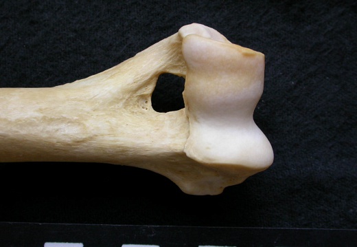 Humerus: distal part