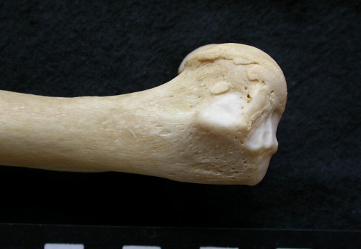 Humerus: distal part