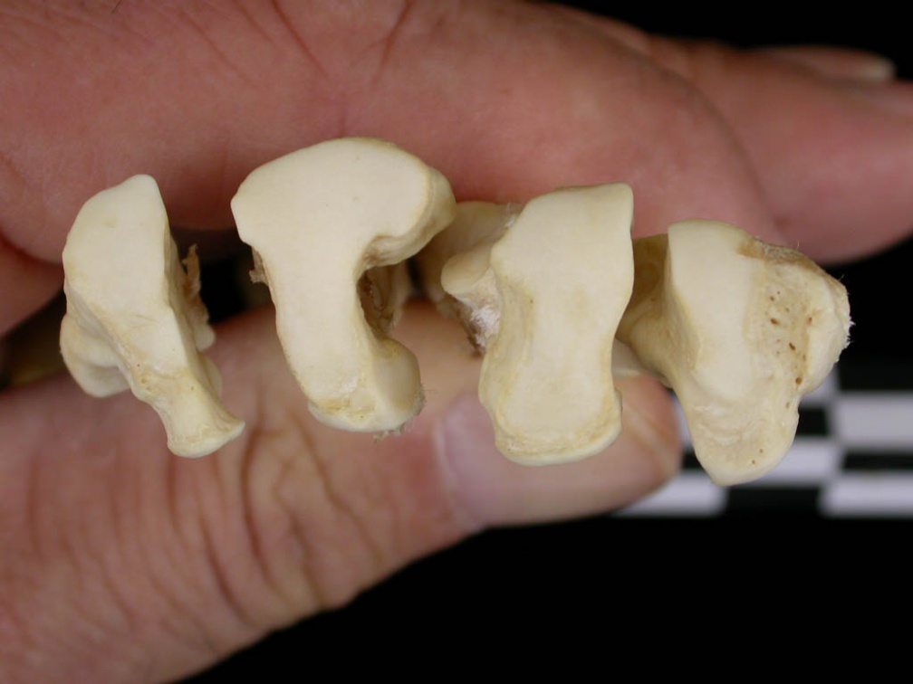 Metatarsianos : parte proximal