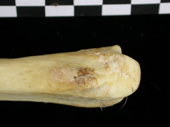 Radius : partie distale