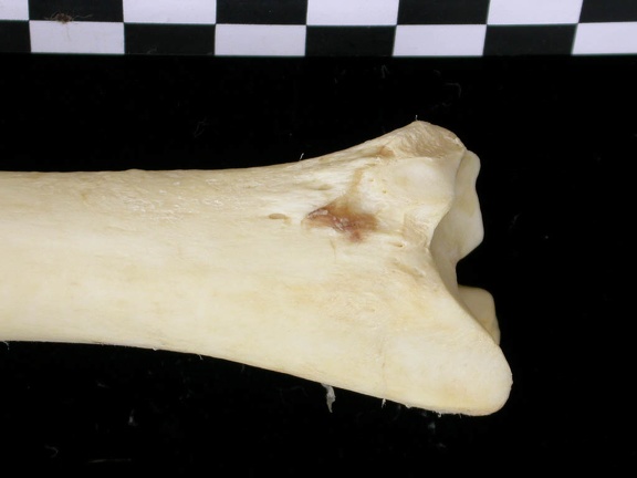  Tibia: distal part