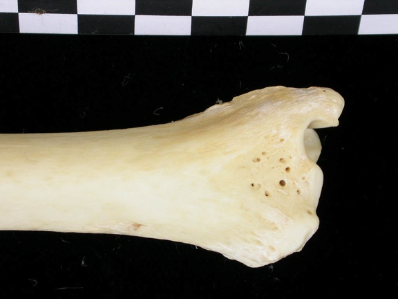  Tibia: distal part