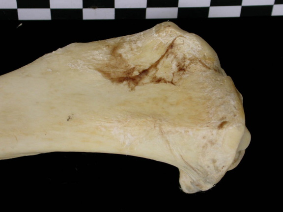 Tibia: parte proximal