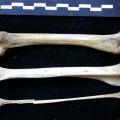 Fémur, tibia et fibula