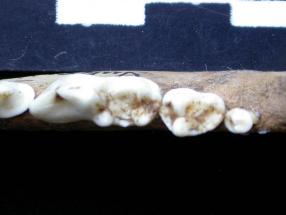 Dentition inférieure