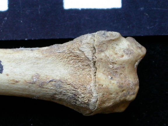 Radius : partie distale