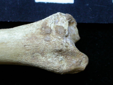  Tibia: distal part