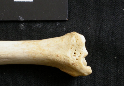  Tibia: distal part