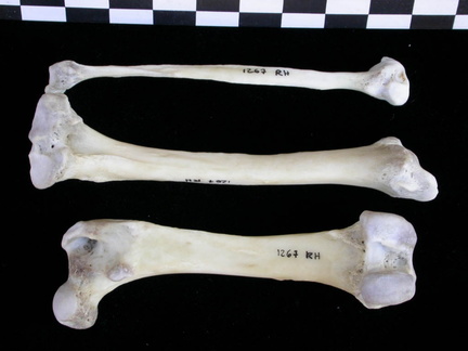 Fémur, tibia et fibula