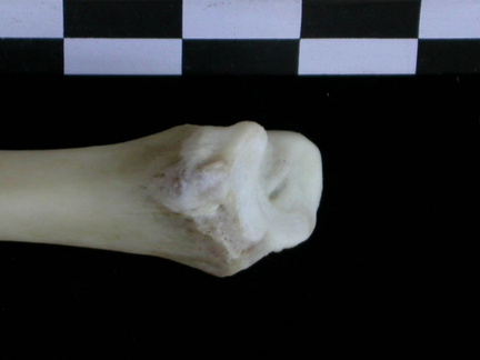  Tibia: distal part