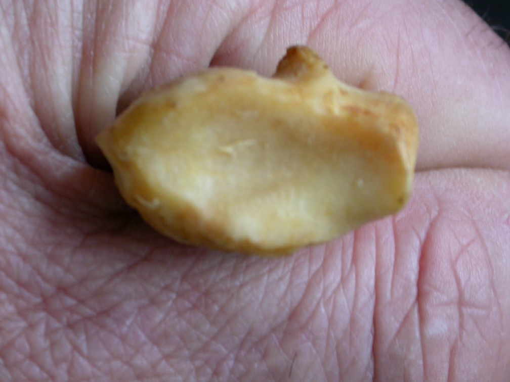 Radius : partie distale