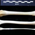 Fémur, tibia et fibula