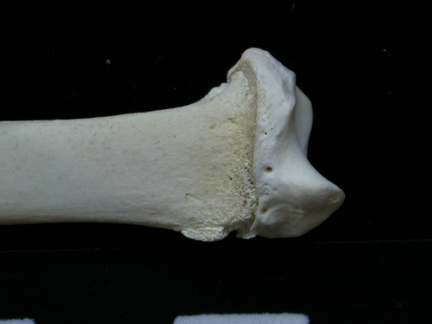 Radio : parte distal