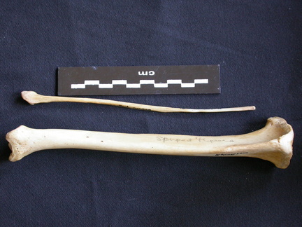 Tibia y fíbula