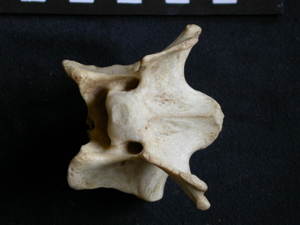 Cervical vertebra