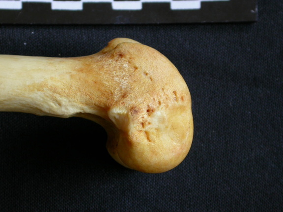 Fémur : parte distal