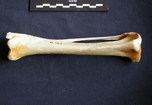 Tibia y fíbula