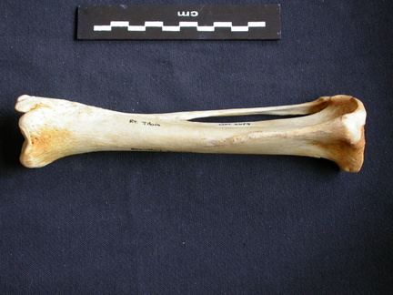 Tibia y fíbula