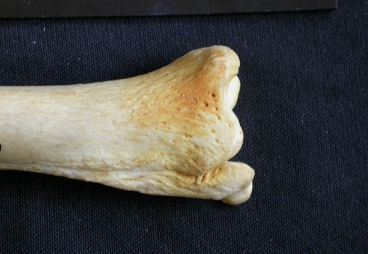 Tibia and fibula: distal part