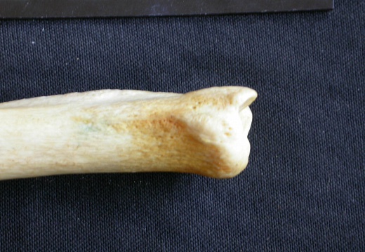 Tibia and fibula: distal part