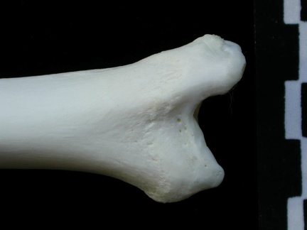  Tibia: distal part