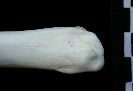  Tibia: distal part