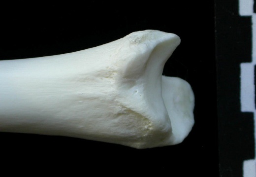  Tibia: distal part