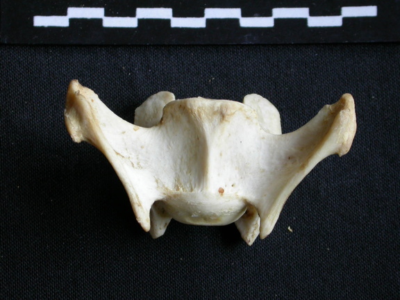 Cervical vertebra