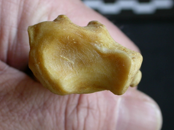 Radius : partie distale