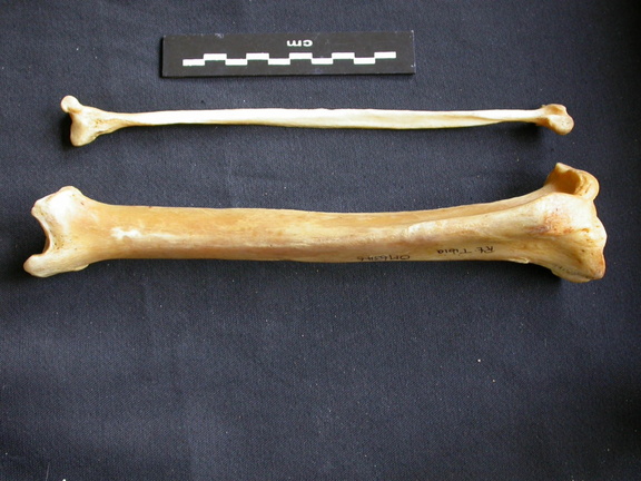 Tibia y fíbula 