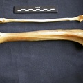 Tibia y fíbula 