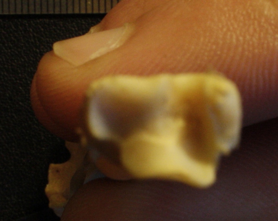 Tibia et fibula : extrémité distale