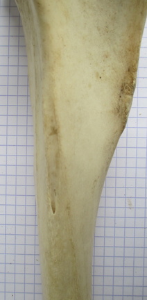 Tibia D diaphyse1
