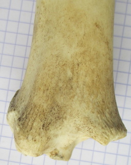 Tibia D dist caud
