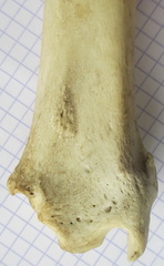 Tibia D dist cran