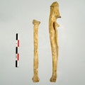 Radius Ulna posterieur