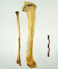 Tibia Fibula posterieur