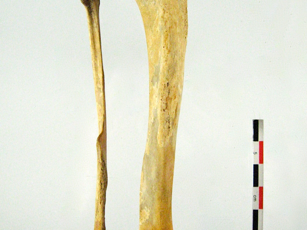 Tibia Fibula posterieur